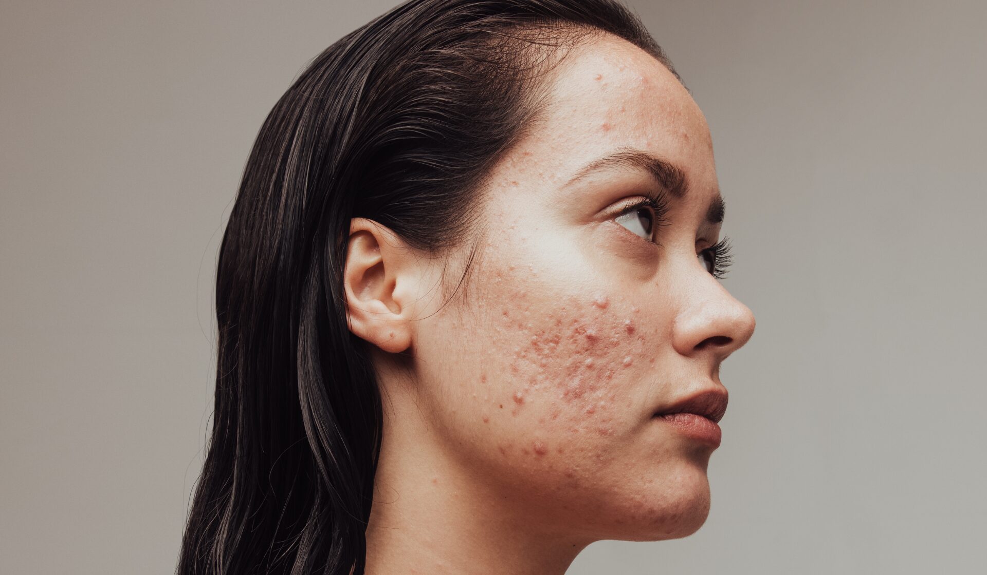 Akne ganzheitlich behandeln im Börner Lebenswerk