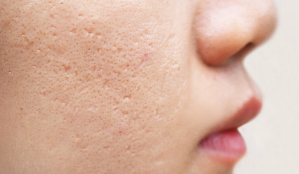 Akne ganzheitlich behandeln im Börner Lebenswerk